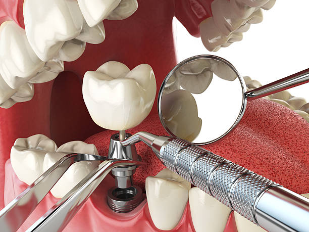 Best Emergency Tooth Extraction in Holbrook, NY